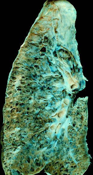Fibrosis pulmonar