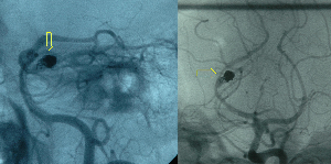 Arteriograma que muestra enrollamiento endovascular
