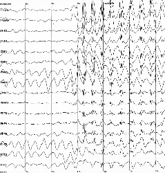 Un EEG que muestra una crisis de ausencia