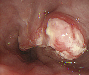 cáncer de esófago