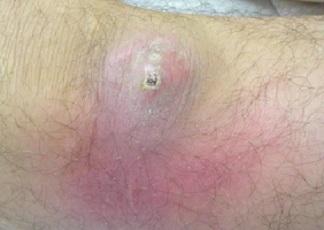 Infección cutánea por MRSA