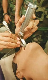 Proceso de intubación para ventilación mecánica