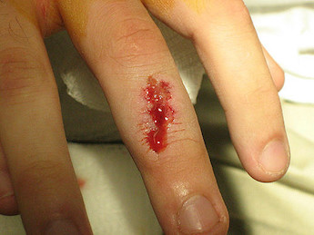 Fractura abierta de dedo