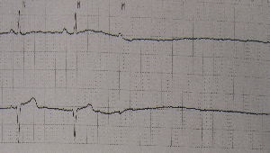 Imagen de línea plana en electrocardiograma