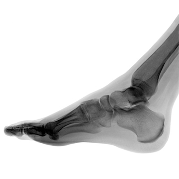 Radiografía para diagnosticar una lesión de Lisfranc