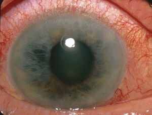 Los síntomas del glaucoma