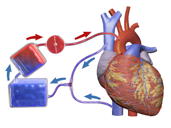 bypass cardiopulmonar