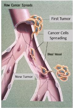 Cómo se propaga el cáncer