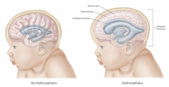 hidrocefalia