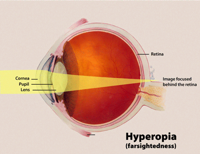 El diagrama muestra que la imagen se forma detrás de la retina de un ojo con hipermetropía