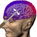 Icepick_Lobotomy