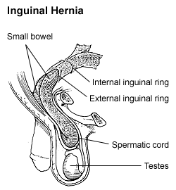 Hernia inguinal
