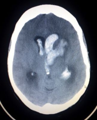 Fotografía de una exploración cerebral de un paciente que muestra manchas blancas brillantes en el cerebro donde hay sangrado.