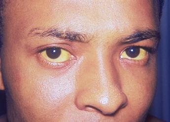 Janundice