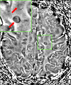 lesiones cerebrales