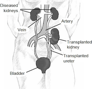 transplante de riñón