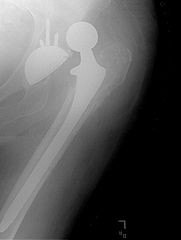 https://commons.wikimedia.org/wiki/File:Dislocated_hip_replacement.jpg