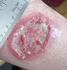 Una lesión causada por leishmaniasis cutánea.