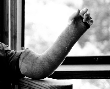 yesos de brazo largo