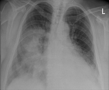radiografía de pulmón