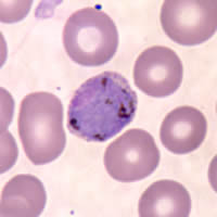 Malaria