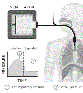 Ventilacion mecanica