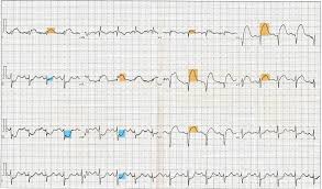 STEMI