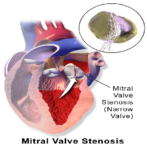 Diagrama de estenosis de la válvula mitral