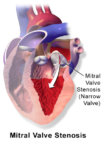 Estenosis mitral