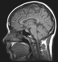 Resonancia magnética cerebral