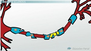 Esclerosis múltiple