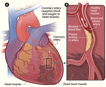 Diagrama del desarrollo del infarto de miocardio.