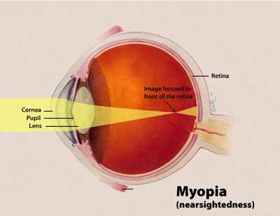 El diagrama muestra cómo se forma la imagen frente a la retina en un ojo miope