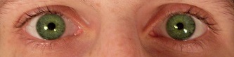 Pupila constreñida, resultado de los fármacos colinérgicos que se toman para el glaucoma