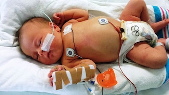 Bebé en tratamiento por sepsis del recién nacido