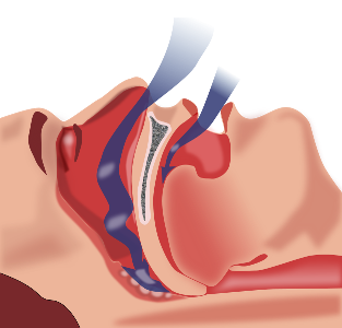 Apnea obstructiva del sueño