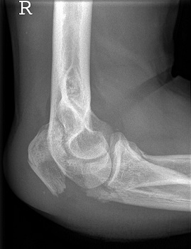 fractura de olécranon