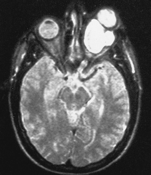 glioma del nervio óptico