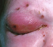 Celulitis orbitaria