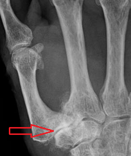 Radiografía de djd en mano