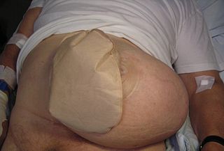Se muestra una hernia paraestomal grave con una bolsa para aparatos