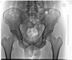 pelvis
