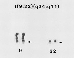Cariotipo de leucemia mieloide crónica