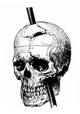 Una barra de hierro a través del cráneo es un cierto ejemplo de lesión cerebral adquirida.
