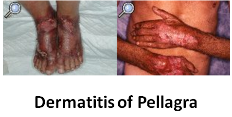 Dermatitis de pelagra