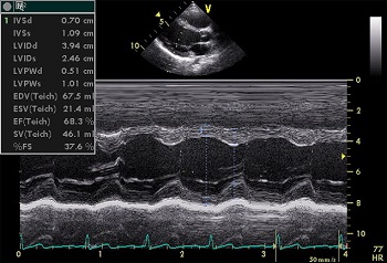 imagen de corazón vista a través de ecocardiograma
