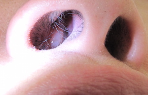 pólipo nasal