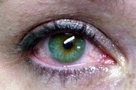 ojos rojos
