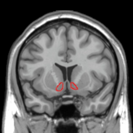 Una imagen de resonancia magnética del cerebro, destacando el núcleo accumbens.