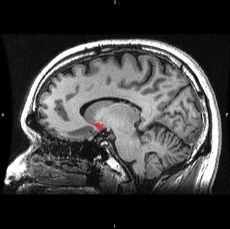 Una imagen de resonancia magnética del cerebro, destacando el núcleo accumbens.